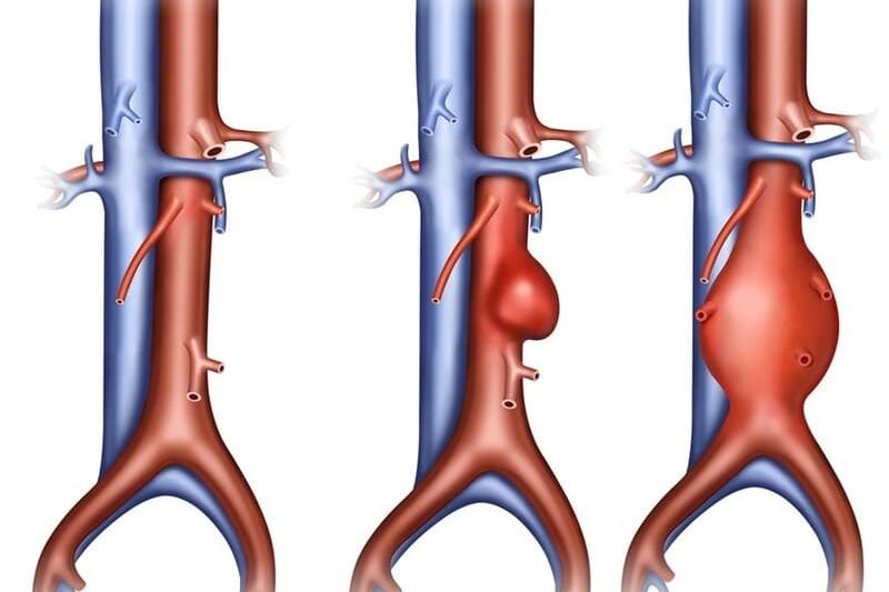 phình động mạch chủ do xơ vữa