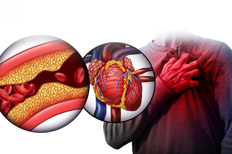 hình thành mảng xơ vữa động mạch