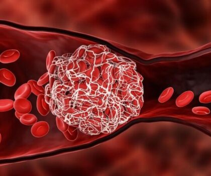 Cục máu đông: Nguyên nhân hình thành, triệu chứng và phòng ngừa