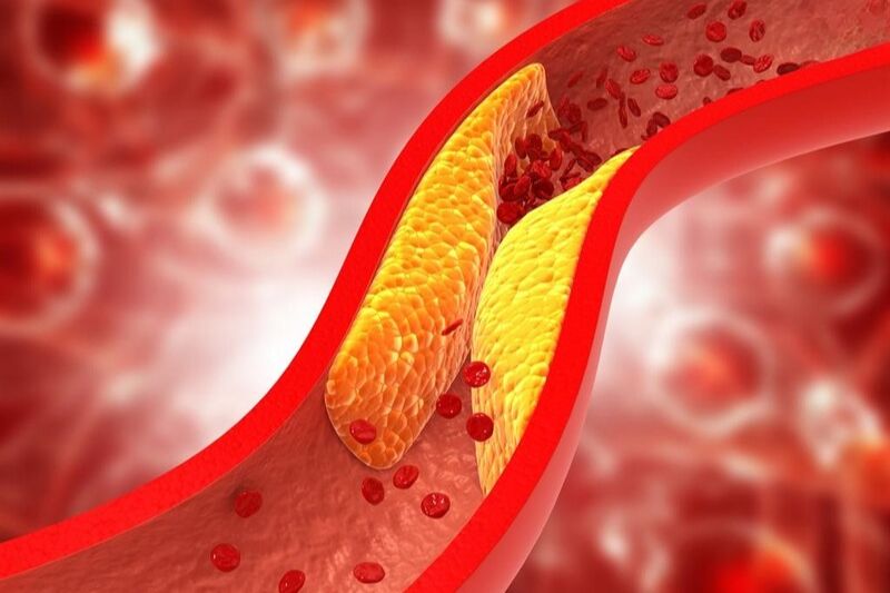 cholesterol cao gây nhồi máu
