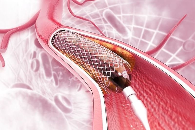 đặt stent điều trị nhồi máu cơ tim