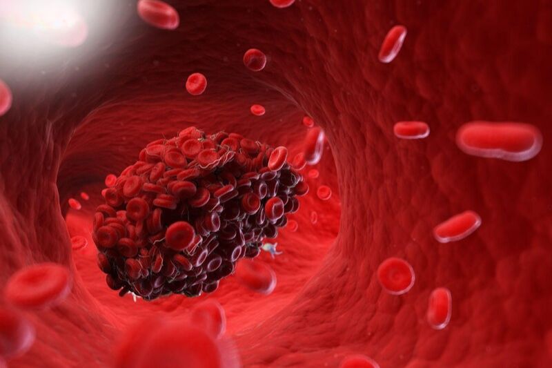 mảng xơ vữa động mạch