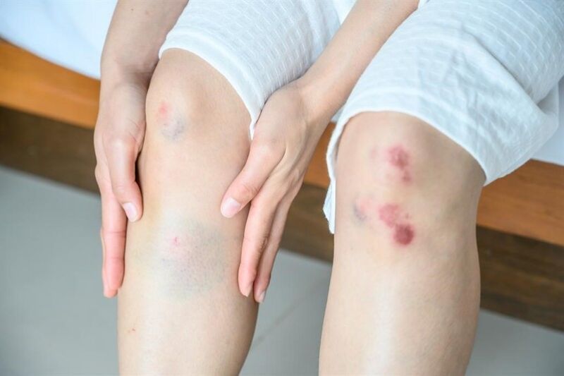 vết bầm trên chân biểu hiện của cục máu đông