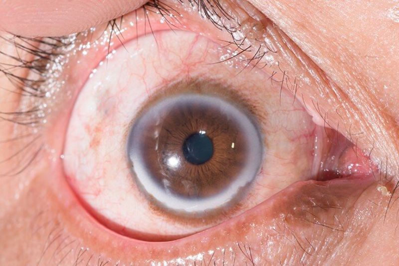 vòng cung trắng xám ở mắt là dấu hiệu rối loạn lipid