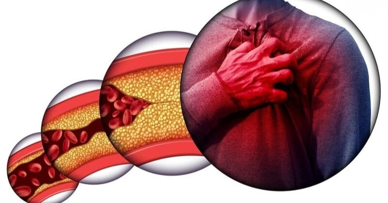 chẩn đoán xơ vữa động mạch