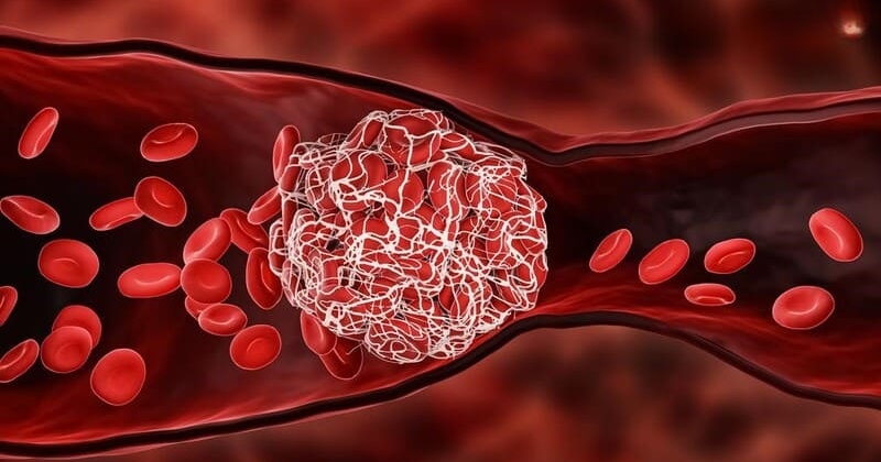 điều trị xơ vữa động mạch