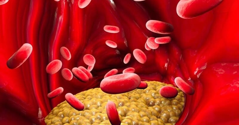 nguyên nhân gây triglyceride cao