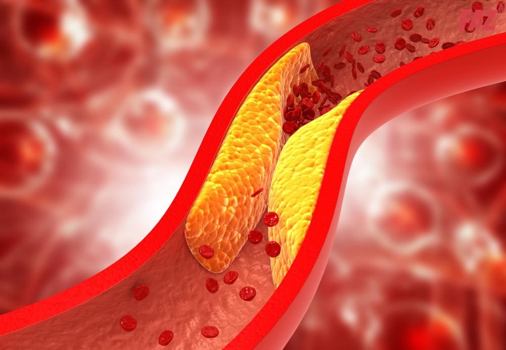Xơ vữa động mạch: Nguyên nhân, triệu chứng, điều trị và chẩn đoán