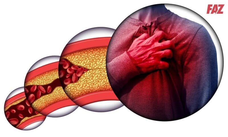 Chẩn đoán xơ vữa động mạch và phương pháp xét nghiệm
