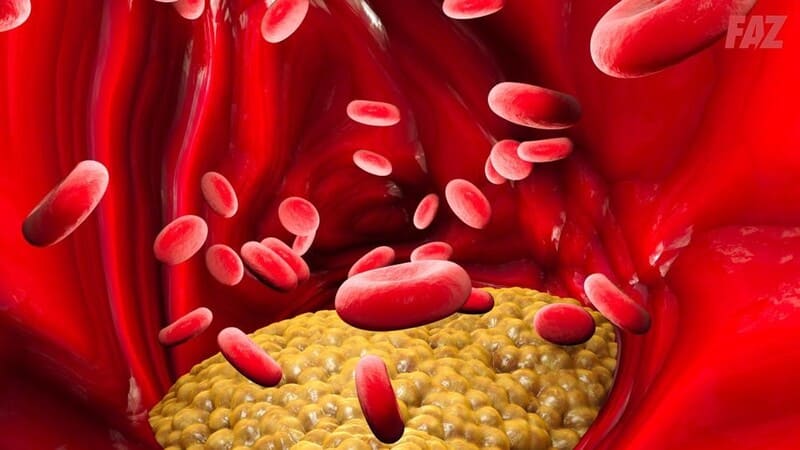 11 nguyên nhân gây Triglyceride cao, biến chứng và cách phòng ngừa