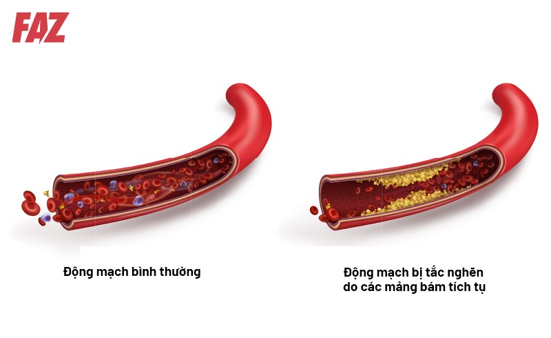 Nhồi máu cơ tim là gì? Nguyên nhân, triệu chứng và cách điều trị