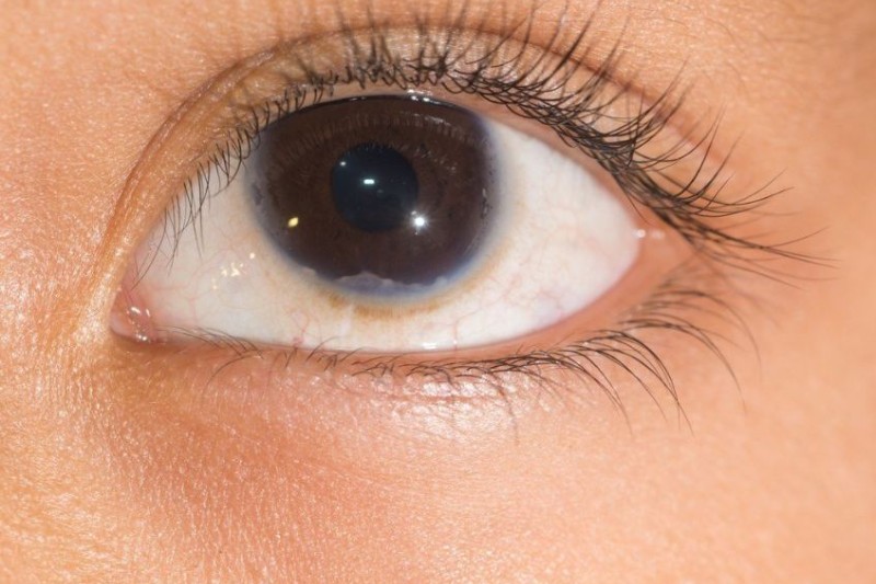 đục rìa giác mạc gây mỡ máu cao