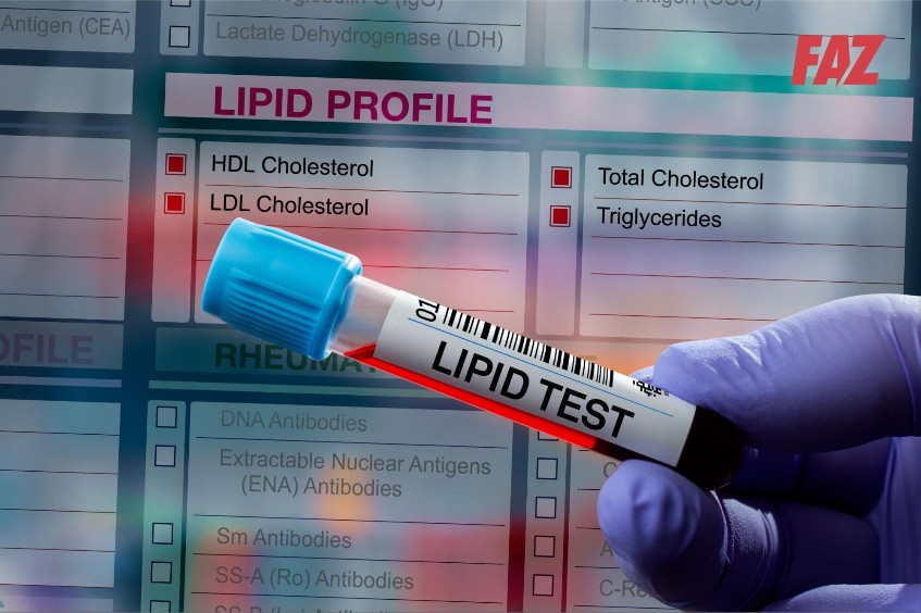 tiêu chuẩn chẩn đoán rối loạn lipid máu