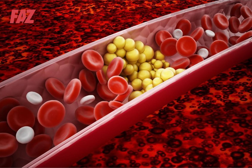 Vì sao cần chẩn đoán rối loạn lipid máu