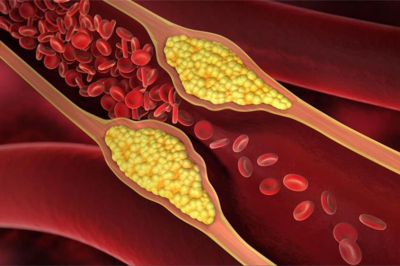 tích tụ triglyceride gây vỡ vữa động mạch