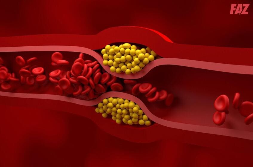 triglyceride cao nguy hiểm như cholesterol xấu