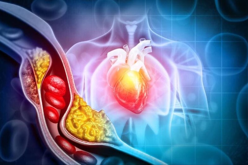 cholesterol và triglyceride là hai thành phần mỡ máu