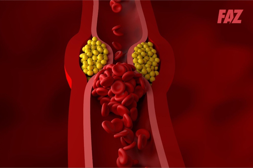 điều trị Triglyceride máu nặng