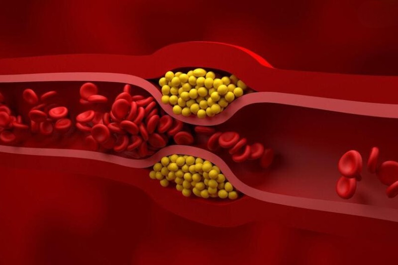 triglyceride và cholesterol cao đều nguy hiểm