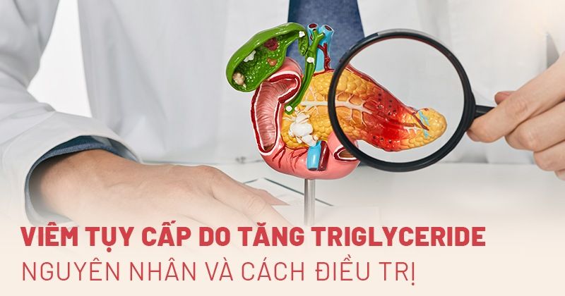 Viêm tụy cấp do tăng Triglyceride: Nguyên nhân và cách điều trị