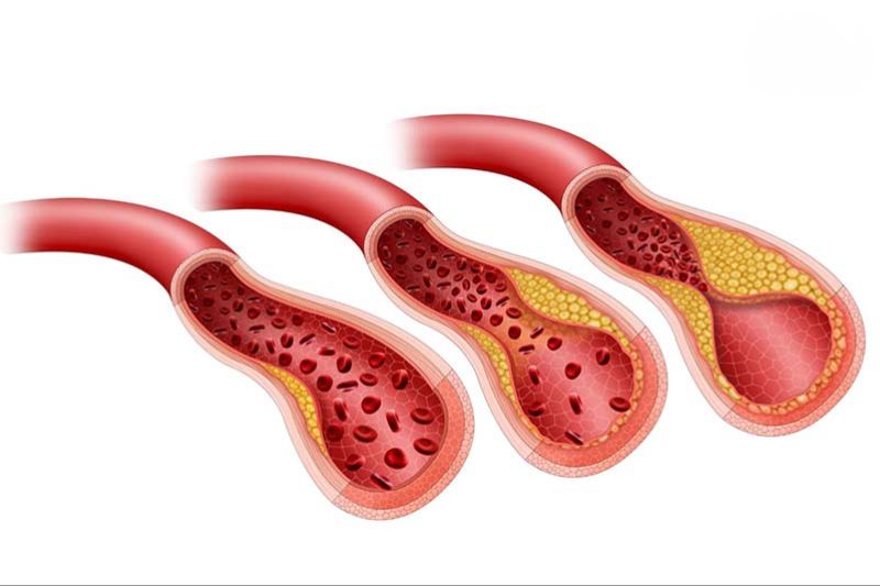 mỡ máu cao có thể dẫn đến sơ vữa