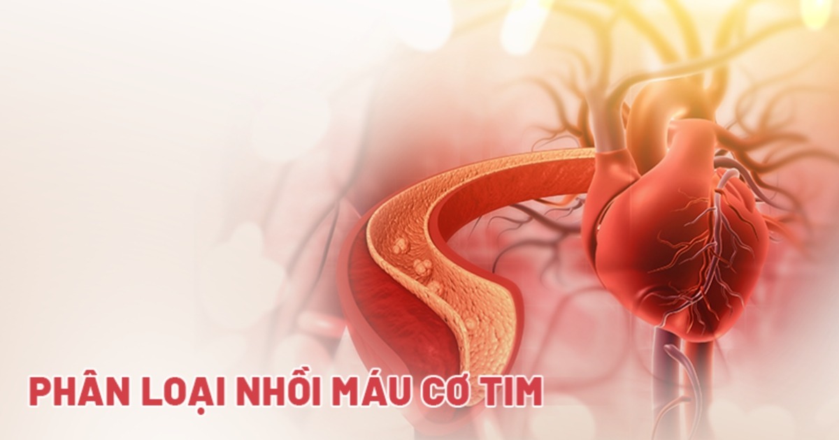 Phân loại nhồi máu cơ tim: Phân biệt 5 nhóm phổ biến