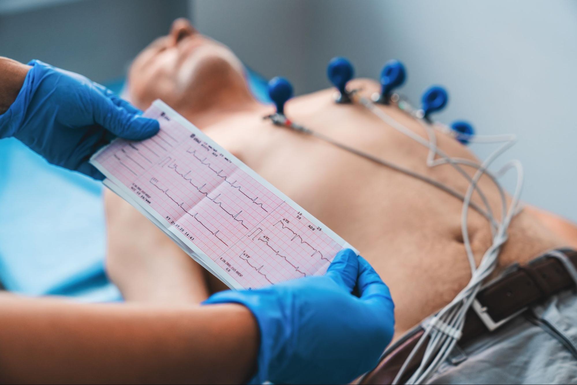 ecg nhồi máu cơ tim không st chênh lên