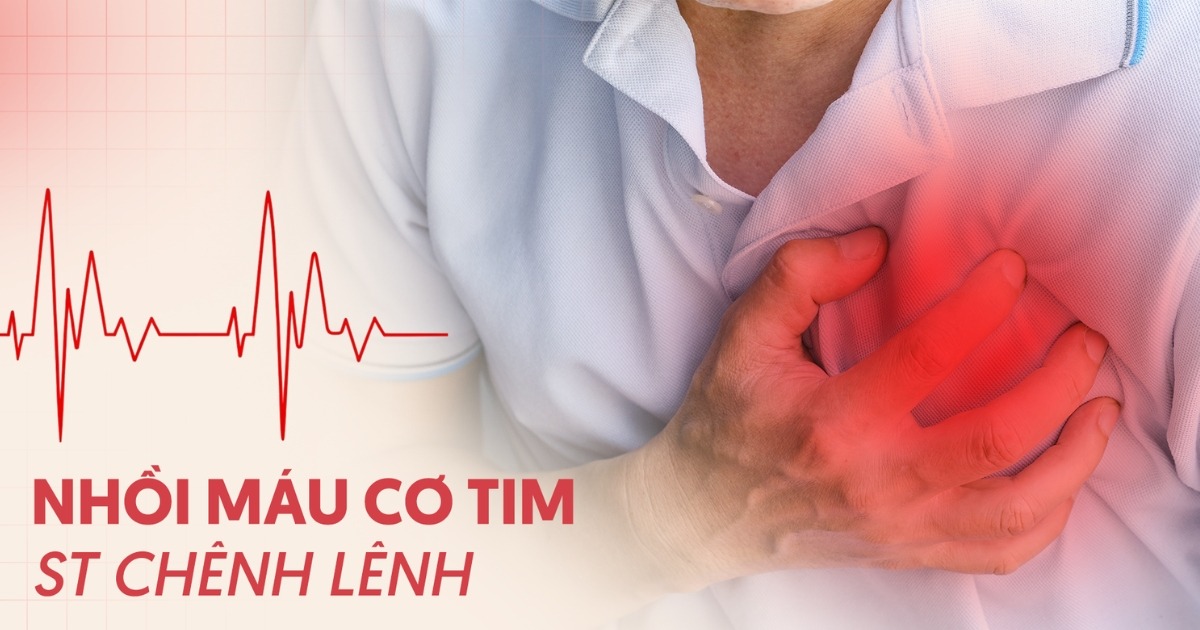 Nhồi máu cơ tim ST chênh lên: Hiểu sao cho đúng?