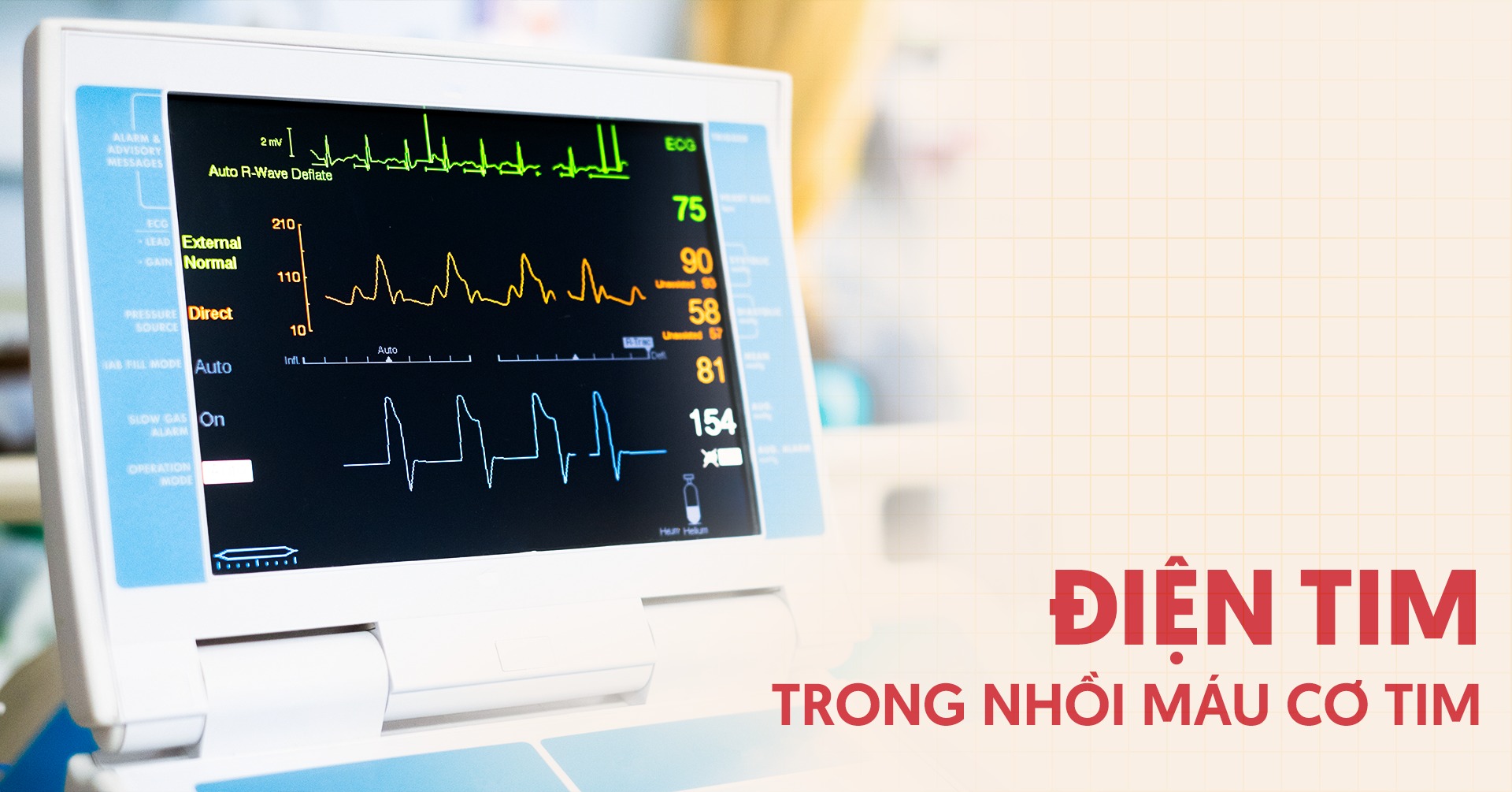 Điện tâm đồ nhồi máu cơ tim: Đặc điểm và cách đọc