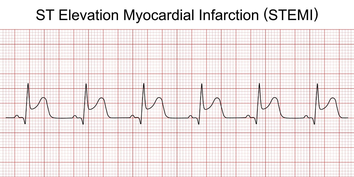 ecg st chênh lên
