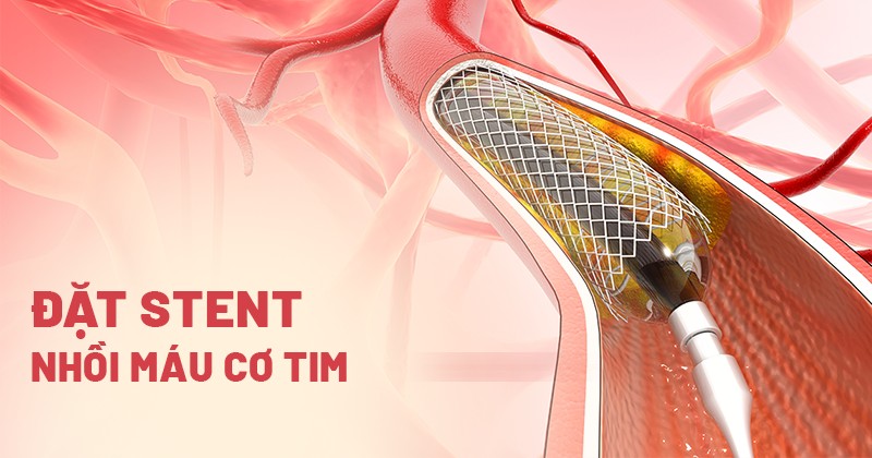 Đặt stent nhồi máu cơ tim: Thời điểm vàng là khi nào?